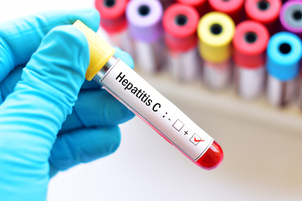 Frasco com amostra de sangue identificado com adesivo de hepatite c