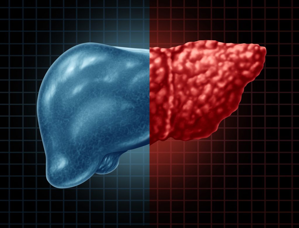 Imagem de um fígado com gordura